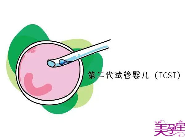 试管一代、二代、三代区别以及适用人群？