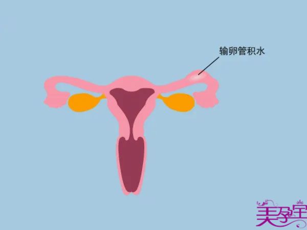 严重的输卵管积水对试管的成功率影响有多大？是否需要结扎输卵管