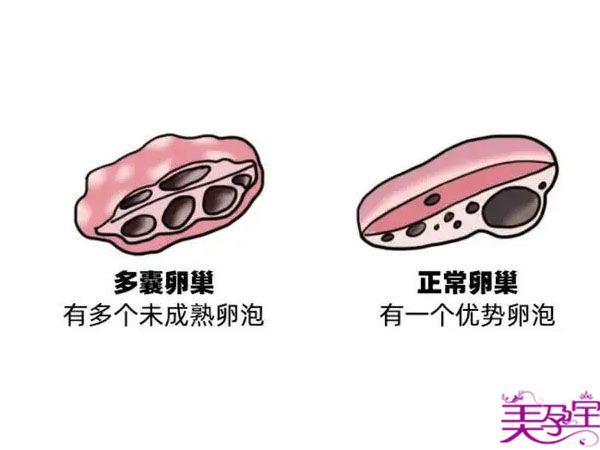 多囊卵巢做试管婴儿成功率高吗?